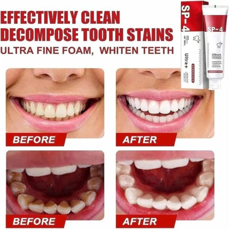 SP-4 Whitening Toothpaste – Gentle Daily Formula Stain Removal - 50% OFF