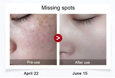 Anti-Blemish & Anti-Aging Tear-Off Mask – Deep Pore Detox - 1+1 FREE