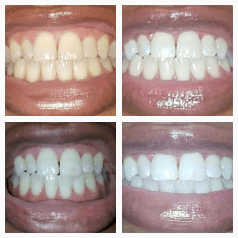 SmileFitPro Whitening Pen - A Whiter Smile, No Sensitivity + 50% OFF