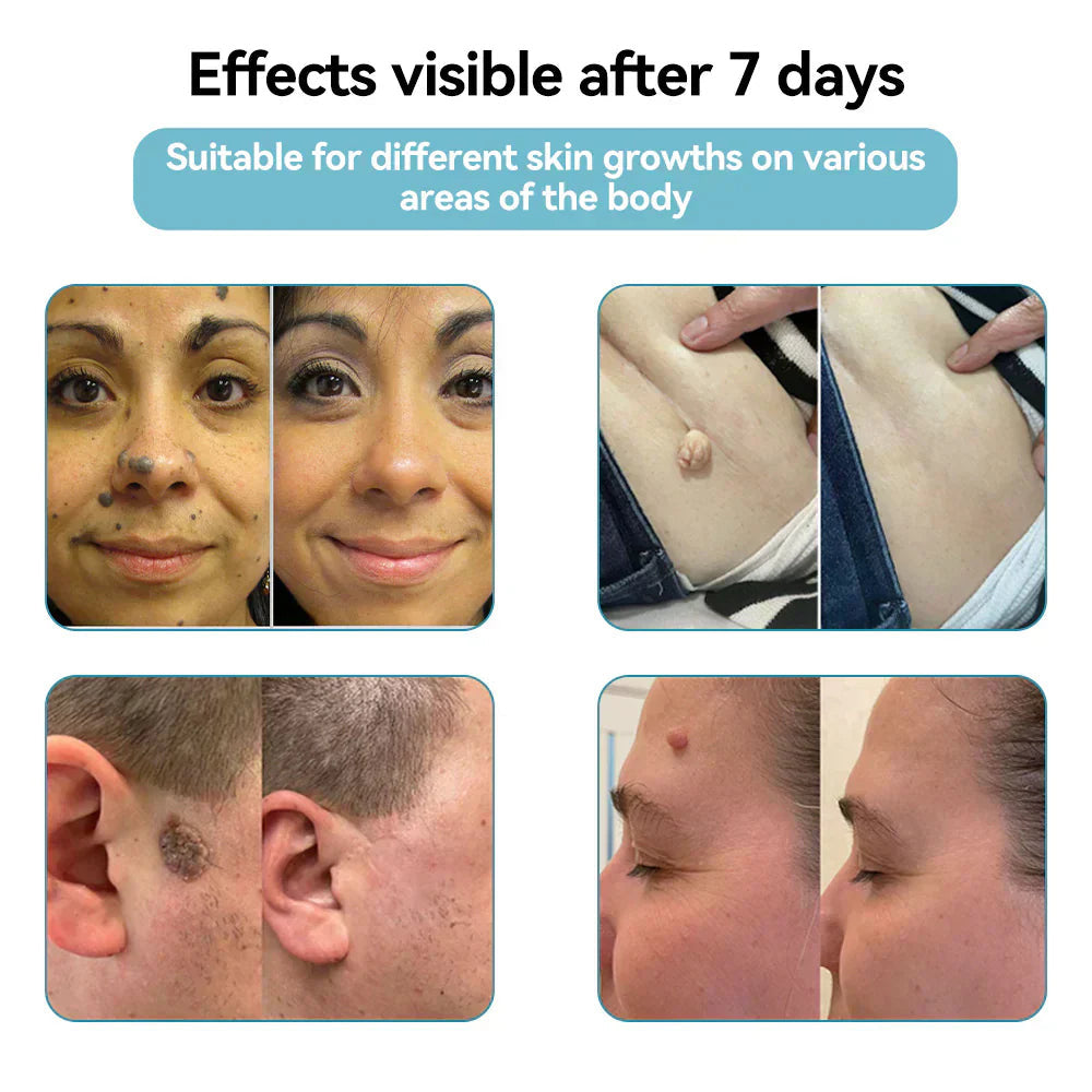 DermaClear Pen - Flawless Skin at Home - 50% OFF