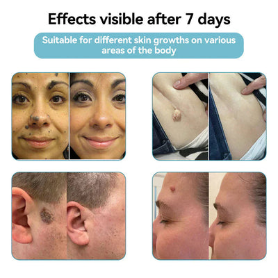 DermaClear Pen - Flawless Skin at Home - 50% OFF