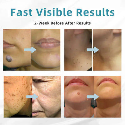 DermaClear Pen - Flawless Skin at Home - 50% OFF