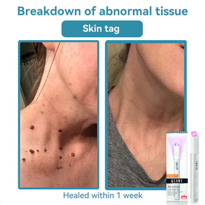 DermaClear Pen - Flawless Skin at Home - 50% OFF