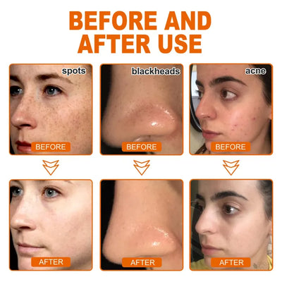 RadianceReveal Peel-Off Mask - Your Spotless Glow Solution - 1 + 1 FREE, 2 + 2 FREE