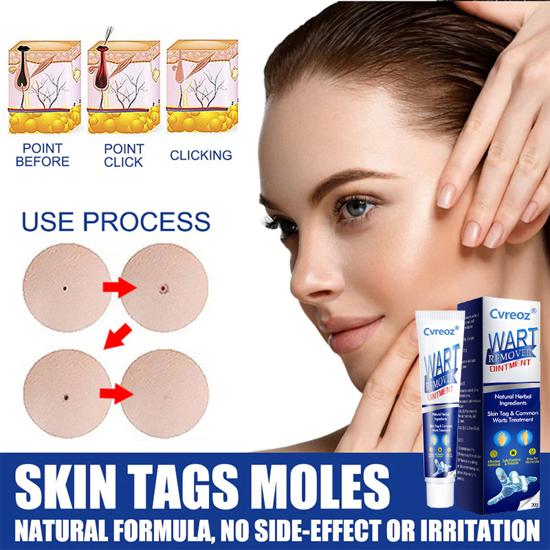 DermaClear Wart Ointment - Your Permanent Skin Solution - 50% OFF