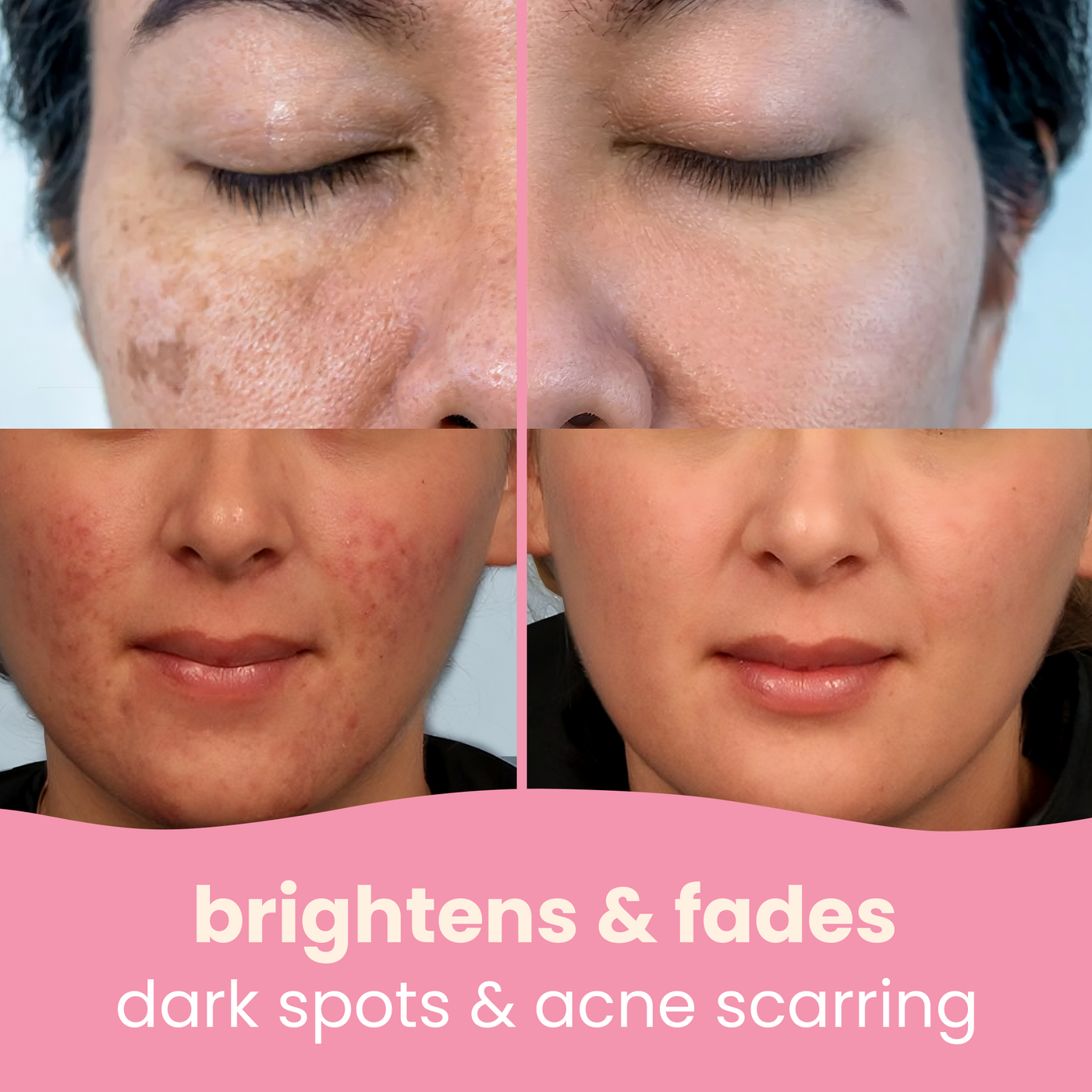 BrightGlow Turmeric & Kojic Acid Pads – Target Dark Spots, Fast - 1+1 FREE