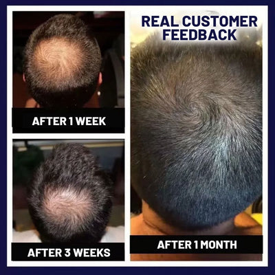 Lovilds Natural Hair Regrowth Spray - Clinically-Inspired Scalp Treatment - 1+1 FREE