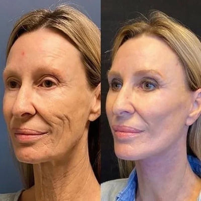 The NeuroTox Serum - The Needle-Free Wrinkle Solution - 50% OFF