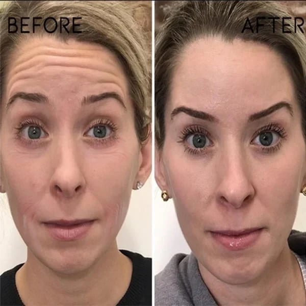 The NeuroTox Serum - The Needle-Free Wrinkle Solution - 50% OFF