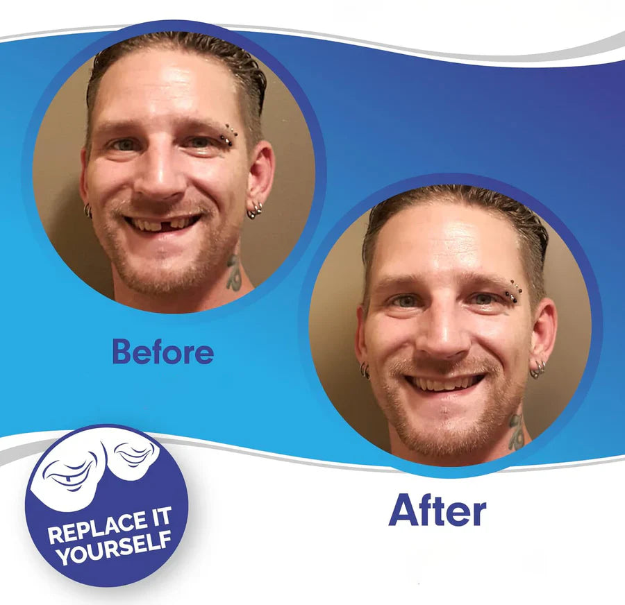 LuminaSmile Instant Confidence Veneers - 50% OFF