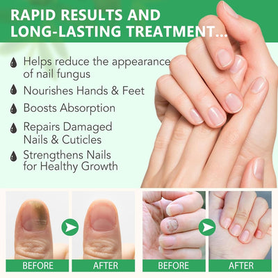 MycoClear Elixir - Clear, Healthy Nails, Fast - 50% OFF