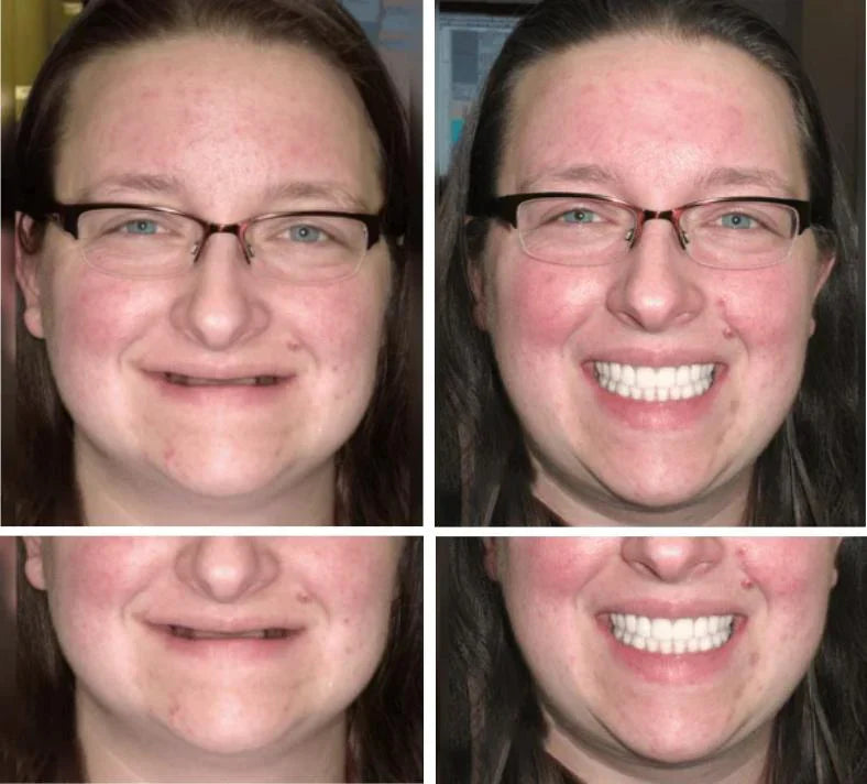 NaturaFit Dentures - The No-Slip, Custom-Fit Smile + 50% OFF