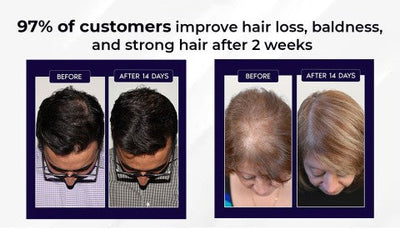 FolliVive - When I Got My Hair Back, I Got Me Back - 50% OFF