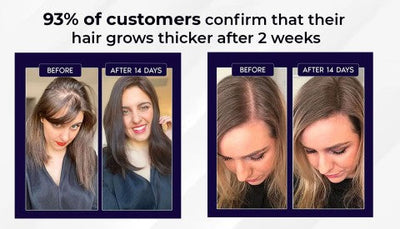 Lovilds Natural Hair Regrowth Spray - Clinically-Inspired Scalp Treatment - 1+1 FREE