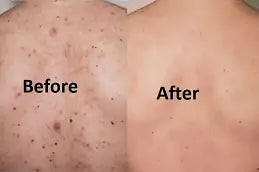 Back Acne Spray Fast-Acting Body Blemish Treatment for Women - Clear Skin Without the Harshness - 1+1 FREE