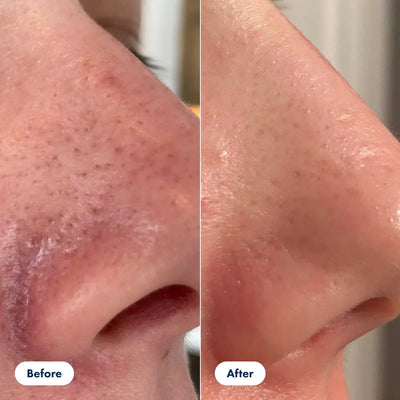 The Glyssa Rice Peel Duo - Your At-Home Glass Skin Facial + 50% OFF