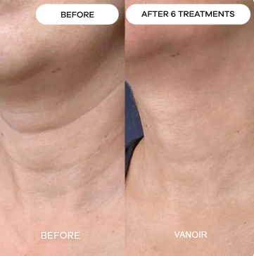 ChronoStamp - Unlock Your Skin's Full Potential - 50% OFF