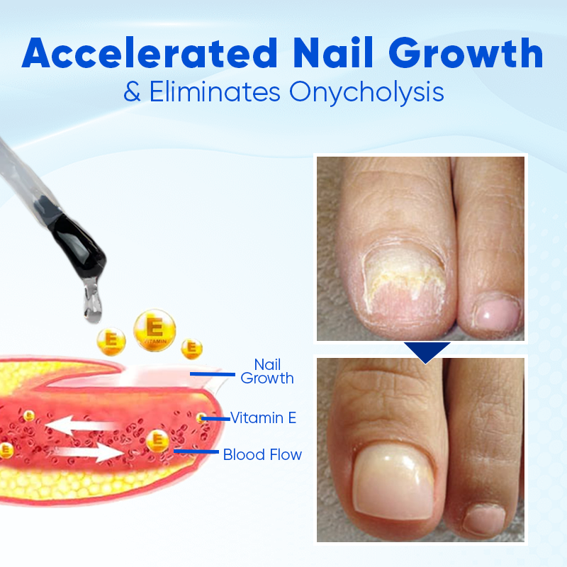 OnyxaCare Nail Growth and Repair Serum – Strengthen, Repair & Grow - 1+1 FREE