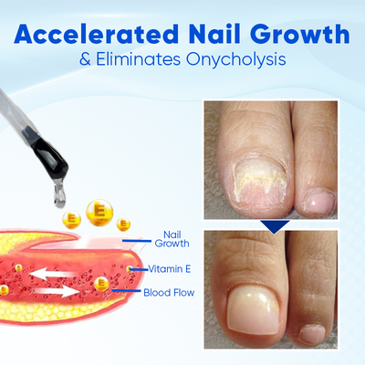 OnyxaCare Nail Growth and Repair Serum – Strengthen, Repair & Grow - 1+1 FREE