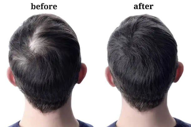 Folli-Gen - Reawaken Your Hair's Fullness - 50% OFF