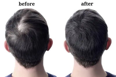 Folli-Gen - Reawaken Your Hair's Fullness - 50% OFF