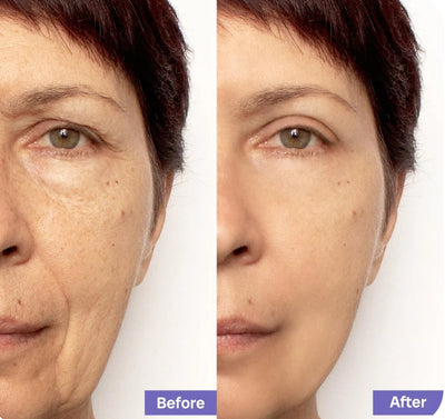 The CollagenMelt System - Restore Your Skin's Plumpness - 1+1 FREE