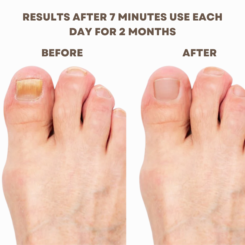 LumiGlow Nail Repair Serum – Reveal Stronger, Healthier Nails Naturally - 50% OFF