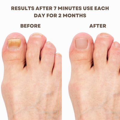 LumiGlow Nail Repair Serum – Reveal Stronger, Healthier Nails Naturally - 50% OFF