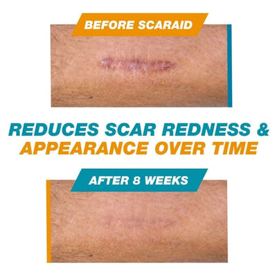 CicaMend Scar Stick - Visibly Fade Your Scars - 50% OFF