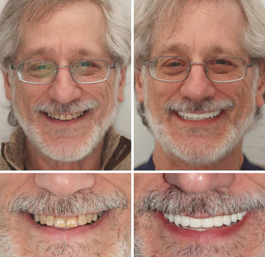 NaturaFit Dentures - The No-Slip, Custom-Fit Smile + 50% OFF