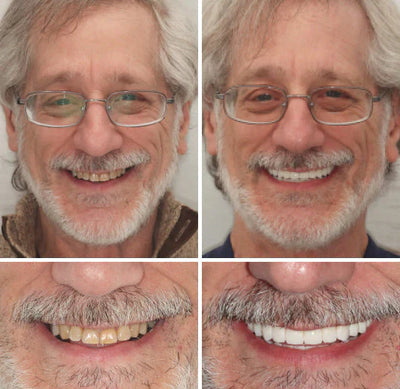 NaturaFit Dentures - The No-Slip, Custom-Fit Smile + 50% OFF