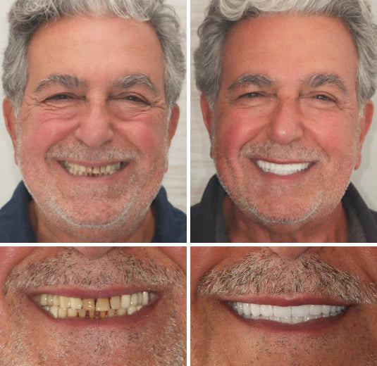 NaturaFit Dentures - The No-Slip, Custom-Fit Smile + 50% OFF