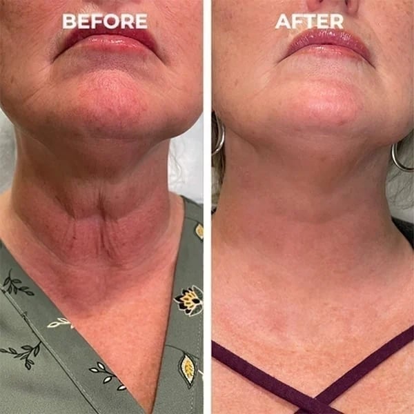 The NeuroTox Serum - The Needle-Free Wrinkle Solution - 50% OFF
