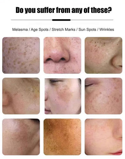 Anti-Blemish & Anti-Aging Tear-Off Mask – Deep Pore Detox - 1+1 FREE