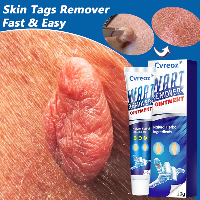 DermaClear Wart Ointment - Your Permanent Skin Solution - 50% OFF