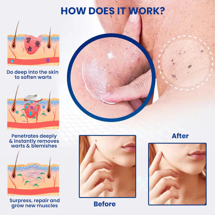 DermaClear Wart Ointment - Your Permanent Skin Solution - 50% OFF